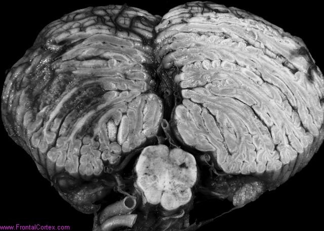 Recent hemorrhagic infarct, right posterior inferior cerebellar artery distribution